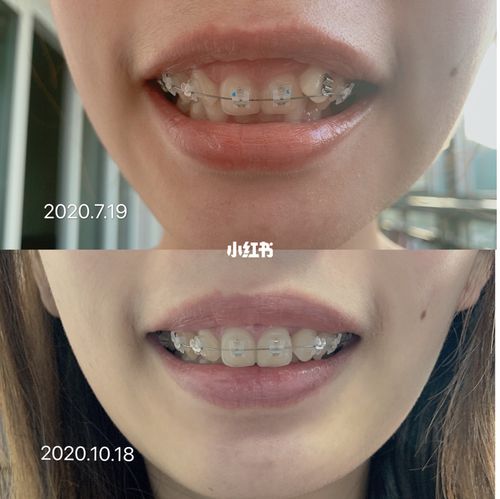 牙齿内倾矫正前后图片，效果变化能有多明显？-图2