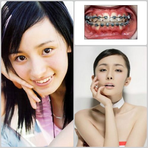明星牙齿矫正前后对比照曝光，颜值变化究竟有多惊艳？-图3