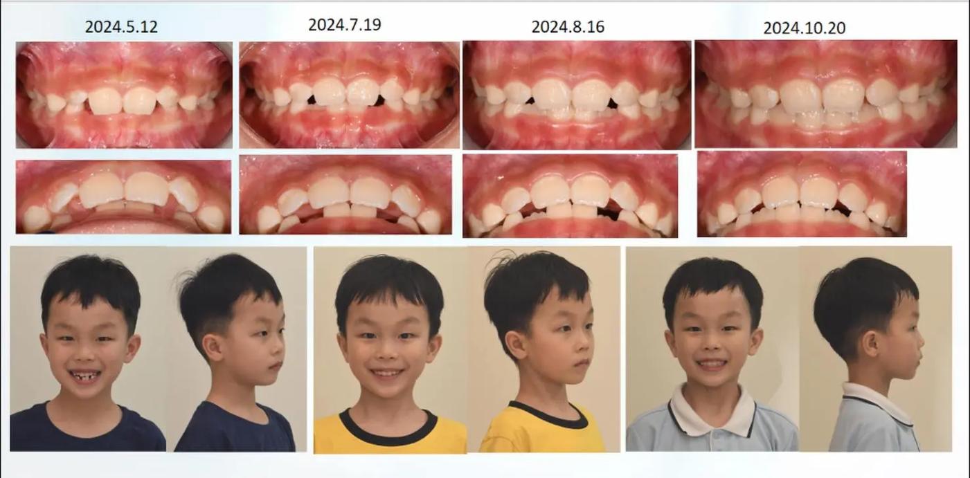牙齿矫正前后脸型变化大不大？矫正效果如何影响脸型？-图2