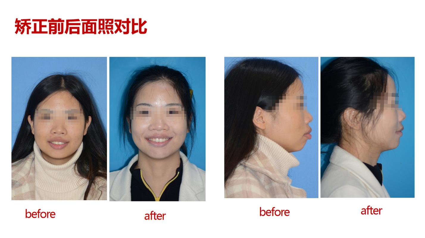 牙齿矫正前后脸型变化大不大？矫正效果如何影响脸型？-图3