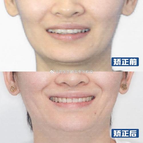 北京牙齿矫正去哪里好？靠谱机构怎么选？-图1