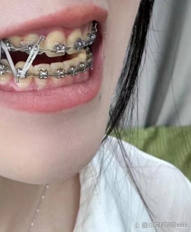 牙齿缝隙可以通过矫正闭合吗？-图1