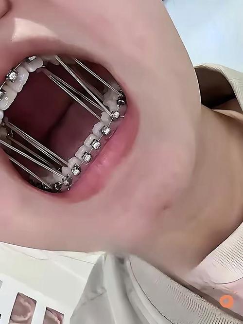 矫正牙齿到底有多痛苦？过程真的很折磨人吗？-图1