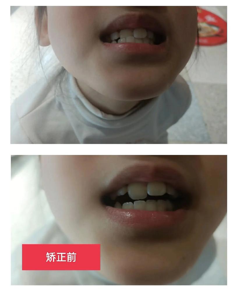 矫正牙齿到底有多痛苦？过程真的很折磨人吗？-图2