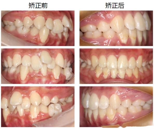 地包天矫正牙齿前照片-图2