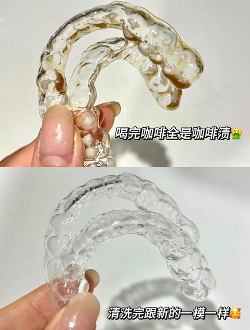 牙齿矫正后不带保持器，矫正效果真的会反弹回原样吗？-图3