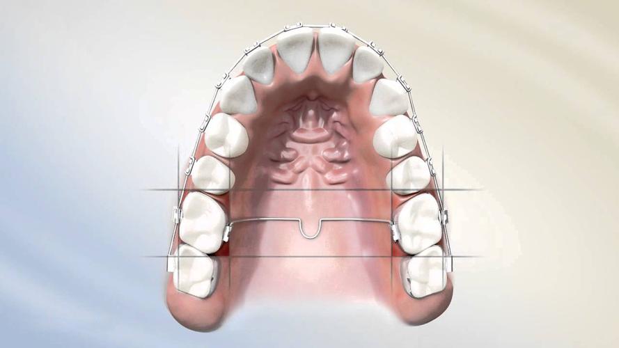 牙齿矫正鄂杆需佩戴多长时间？-图3