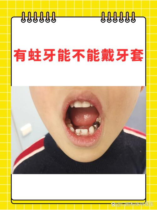 蛀牙能做牙齿矫正吗？-图2