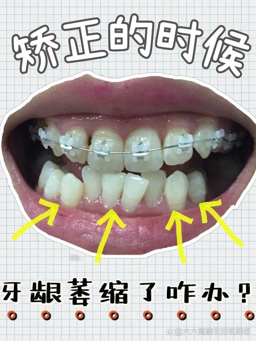 矫正牙齿会导致牙龈萎缩吗？图片揭秘风险与应对-图1