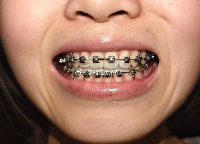 惠州牙齿矫正去哪里好？专业机构怎么选？-图2