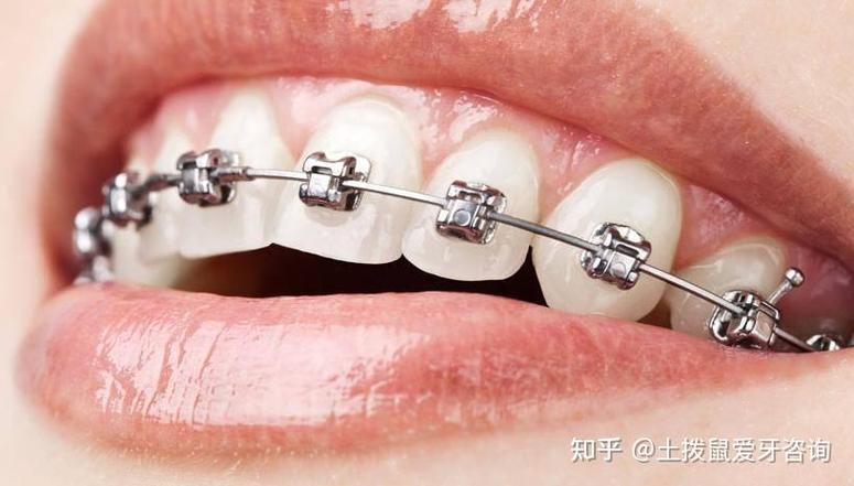 上海矫正牙齿去哪儿好？医院口碑与医生技术怎么选？-图1