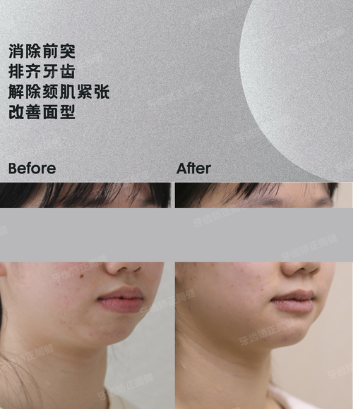 矫正牙齿真的会让嘴唇变厚吗？矫正后嘴唇厚度会有变化吗？-图1