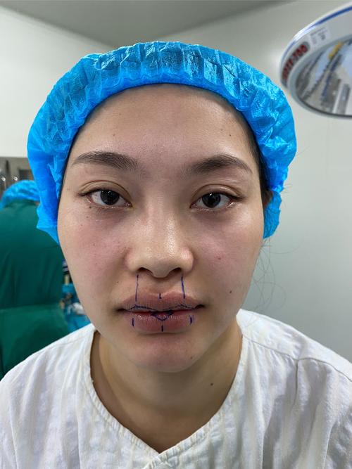 矫正牙齿真的会让嘴唇变厚吗？矫正后嘴唇厚度会有变化吗？-图3