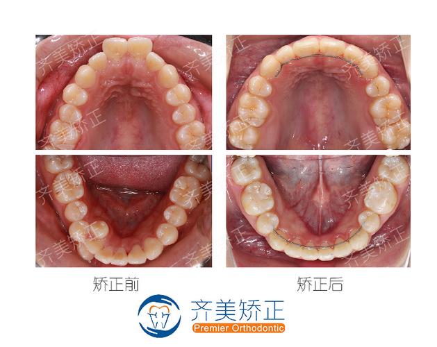 拔牙矫正牙齿前后图片-图2
