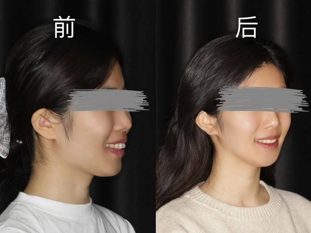 拔牙矫正牙齿前后图片-图3