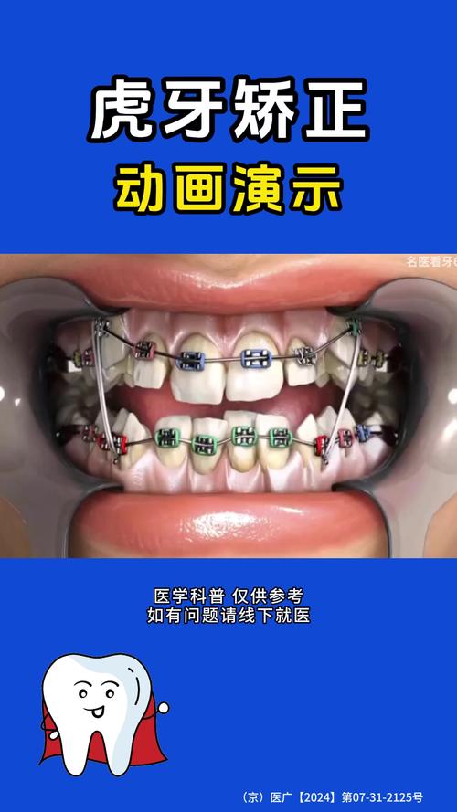 牙齿矫正拉虎牙一般需要多久？-图2