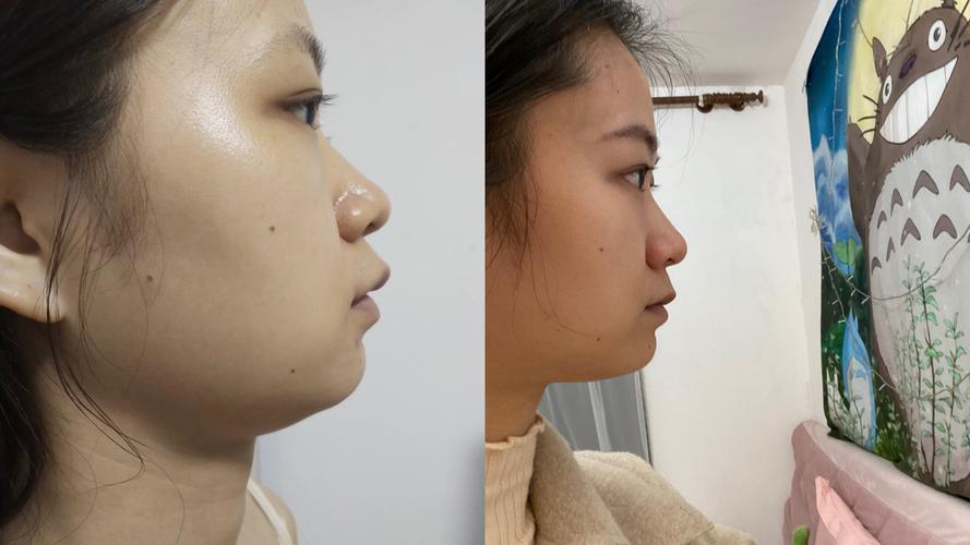 矫正牙齿后脸型会变化吗？变化程度如何？-图2