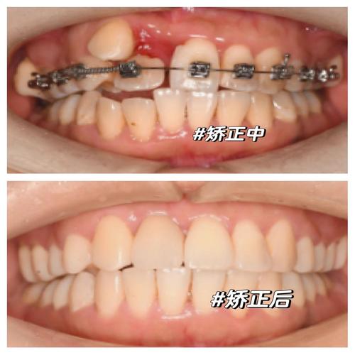 成人虎牙矫正可行吗？牙齿还能排齐吗？-图2