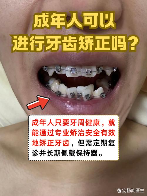 成人牙齿矫正还能做吗？-图2