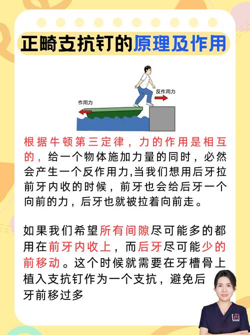 牙齿矫正种植钉是什么?矫正牙齿的关键工具?-图2 牙齿矫正种植钉是什么?矫正牙齿的关键工具?-图2