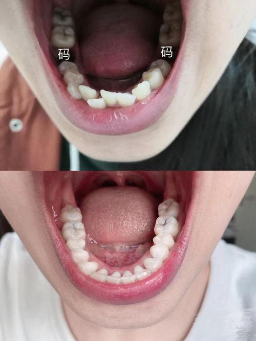 18岁矫正牙齿晚不晚？现在开始还来得及吗？-图2