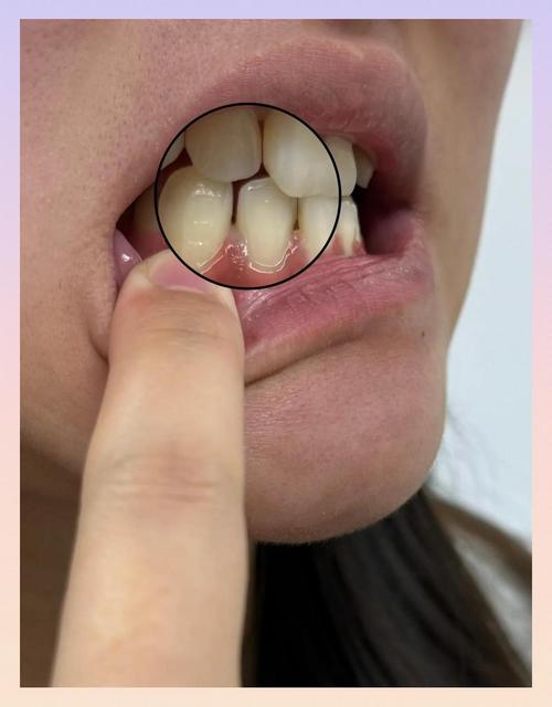 牙齿矫正期间牙龈萎缩-图1