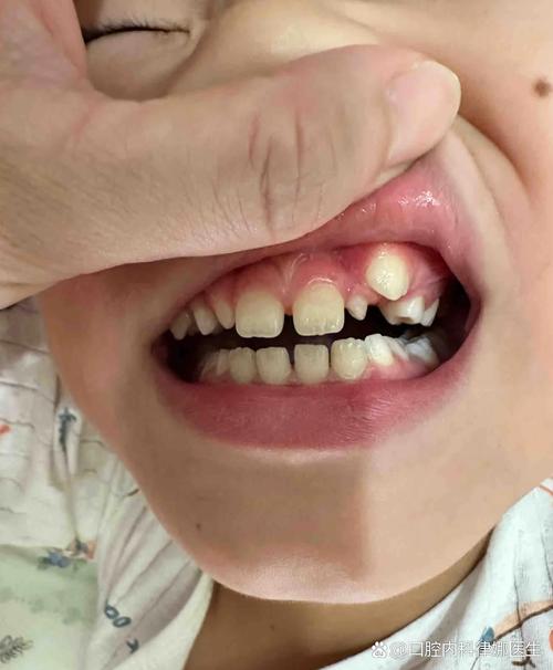 矫正牙齿能保留虎牙吗-图3