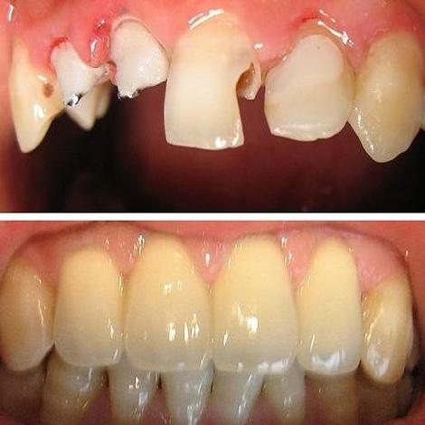 有陶瓷牙可以矫正牙齿-图3