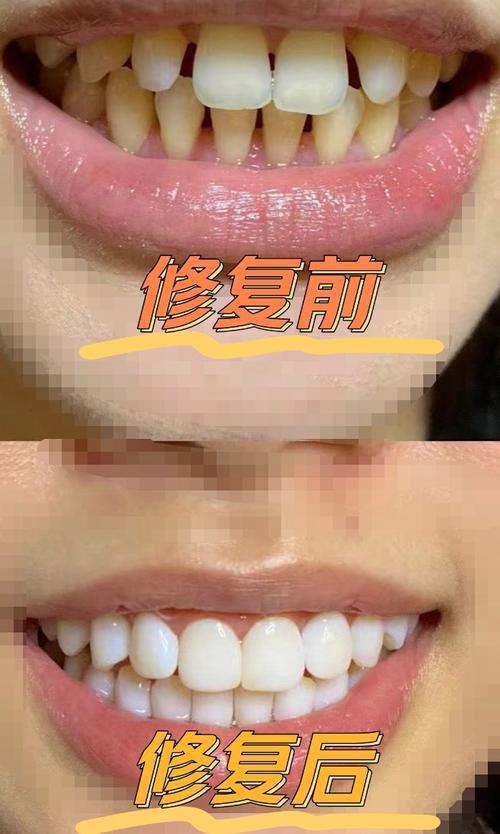 牙齿矫正以后牙缝变大-图3