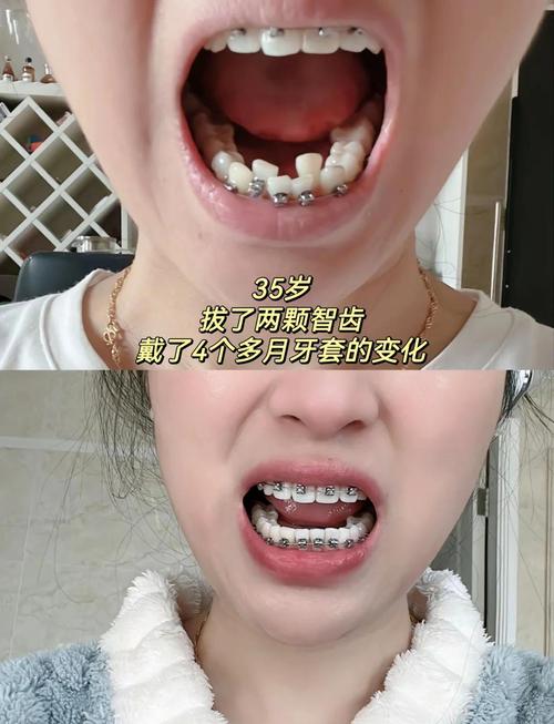 35岁矫正牙齿还适合吗？成年人矫正来得及吗？-图1