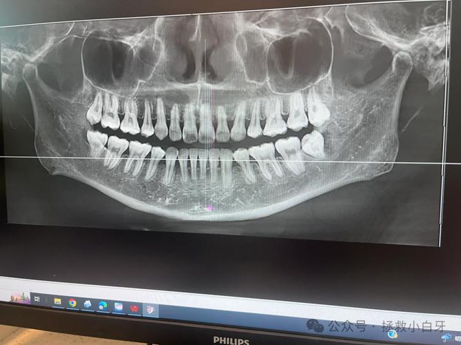 矫正牙齿前，拍CT是必须的吗？-图1