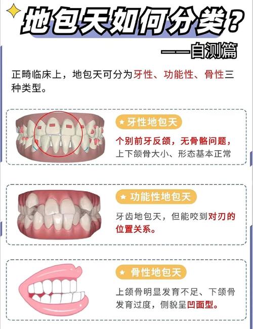 矫正牙齿咬合垫要戴多久?-图1 矫正牙齿咬合垫要戴多久?-图1