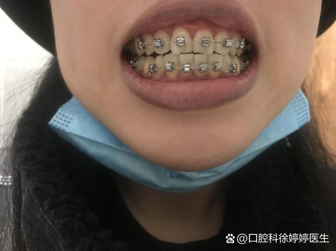 牙齿矫正之后带保持器-图3