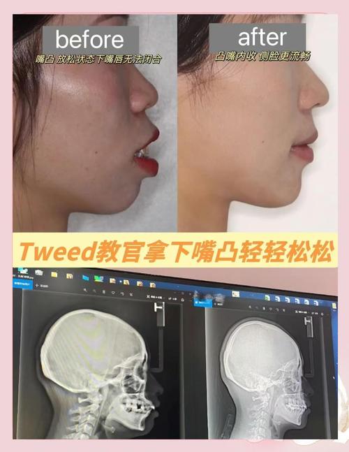 34岁了，矫正牙齿还来得及吗？-图1