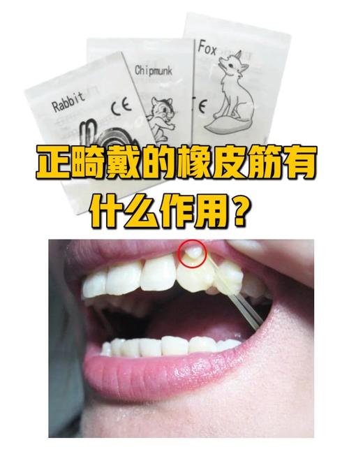 矫正牙齿挂皮筋的作用究竟是什么？-图2