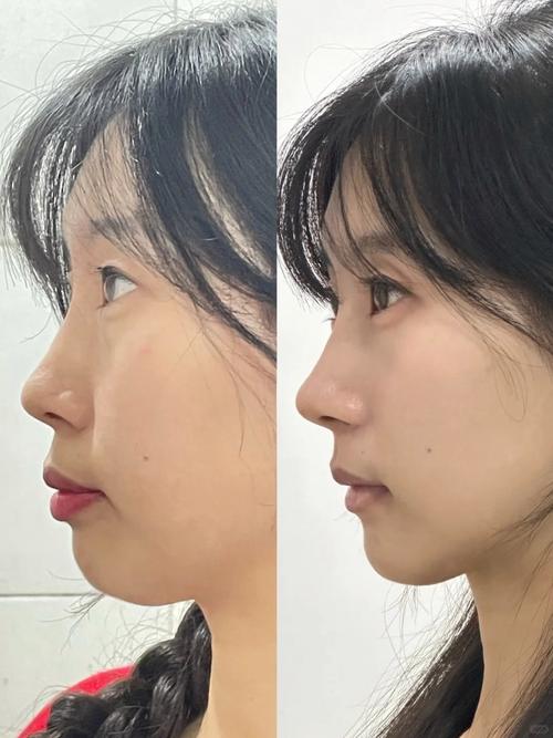 矫正牙齿真能改变脸型？效果因人而异吗？-图1