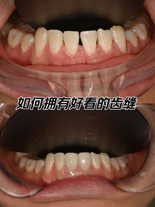 矫正后牙缝收不完，到底是什么原因？-图2