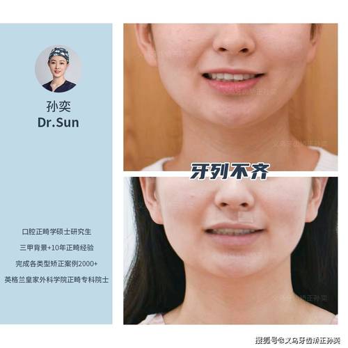 牙齿不整齐不想矫正，还有其他办法吗？-图2