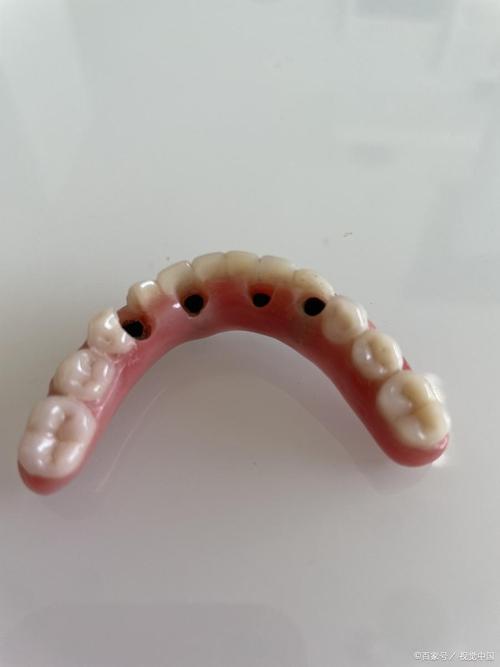 矫正牙齿的材料有哪些？不同材料有何区别与应用？-图3