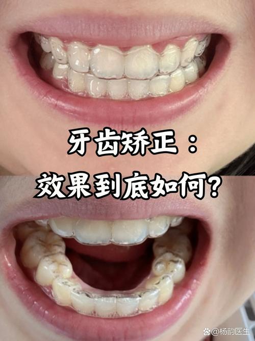 矫正牙齿磨牙的效果究竟如何？对牙齿矫正效果影响大吗？-图1