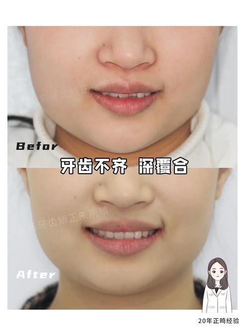 牙齿矫正有失败案例吗-图3