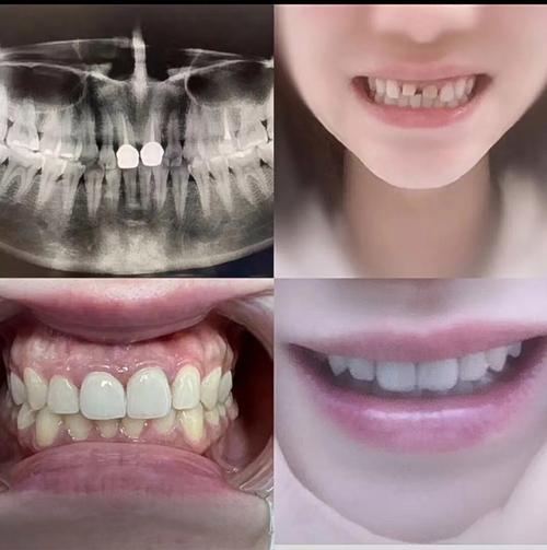 矫正后门牙为何留缝隙？是矫正失败还是正常现象？-图1