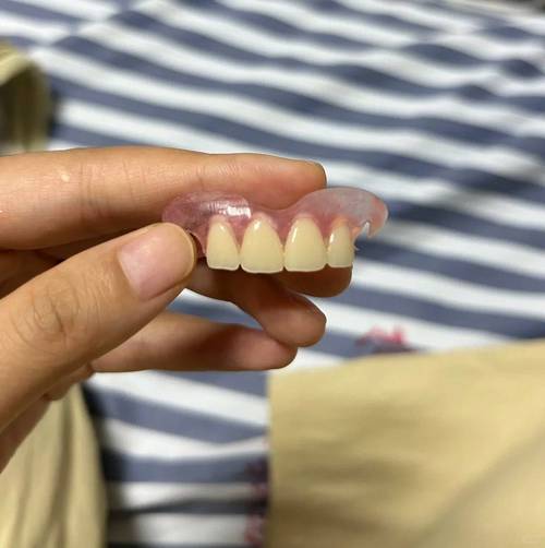 矫正后门牙为何留缝隙？是矫正失败还是正常现象？-图3