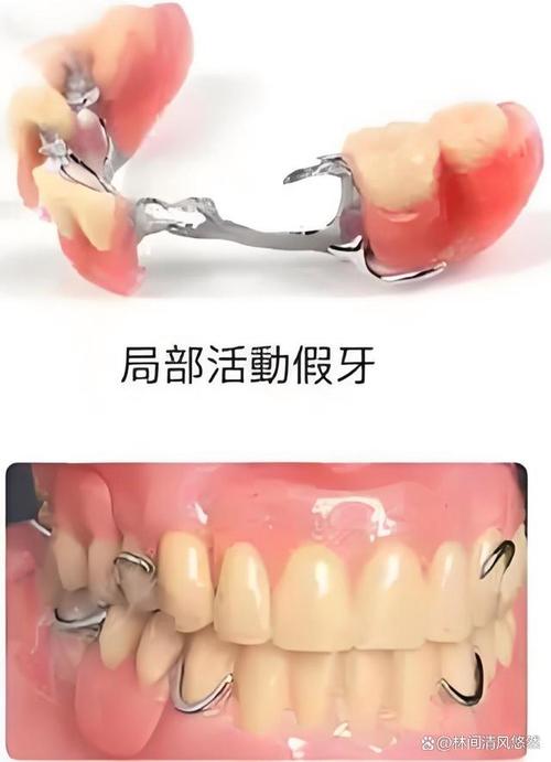 有假牙还能做牙齿矫正吗？-图2