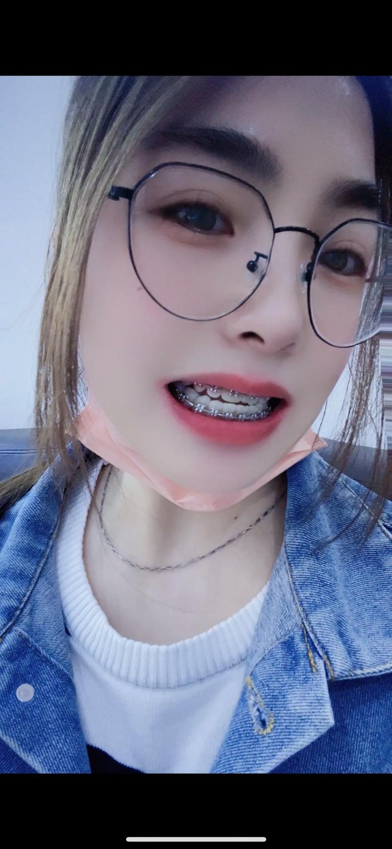 35岁矫正牙齿晚不晚？中年变美还有机会吗？-图1