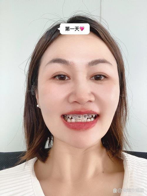 35岁矫正牙齿晚不晚？中年变美还有机会吗？-图3