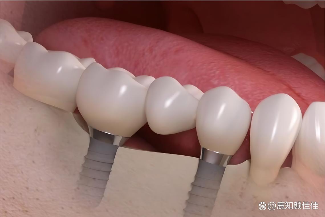 江西拜博口腔牙齿矫正效果与价格怎么样？-图1