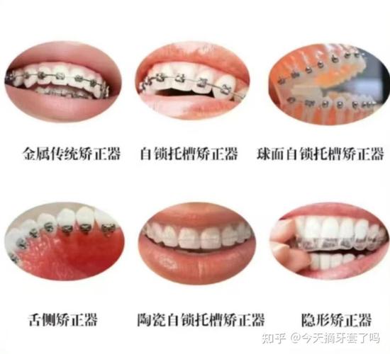南通牙齿矫正哪家好？求推荐靠谱机构！-图3