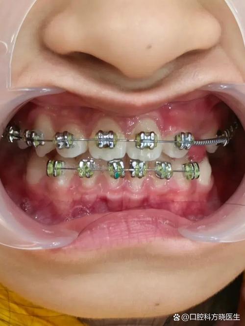 矫正牙齿后上下无法咬合，是什么原因导致的？-图1