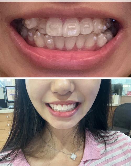 成人隐形矫正牙齿图片-图3